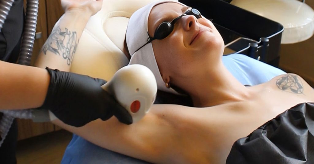 depilación láser axilas precio